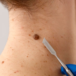 Biopsie cancer de la peau